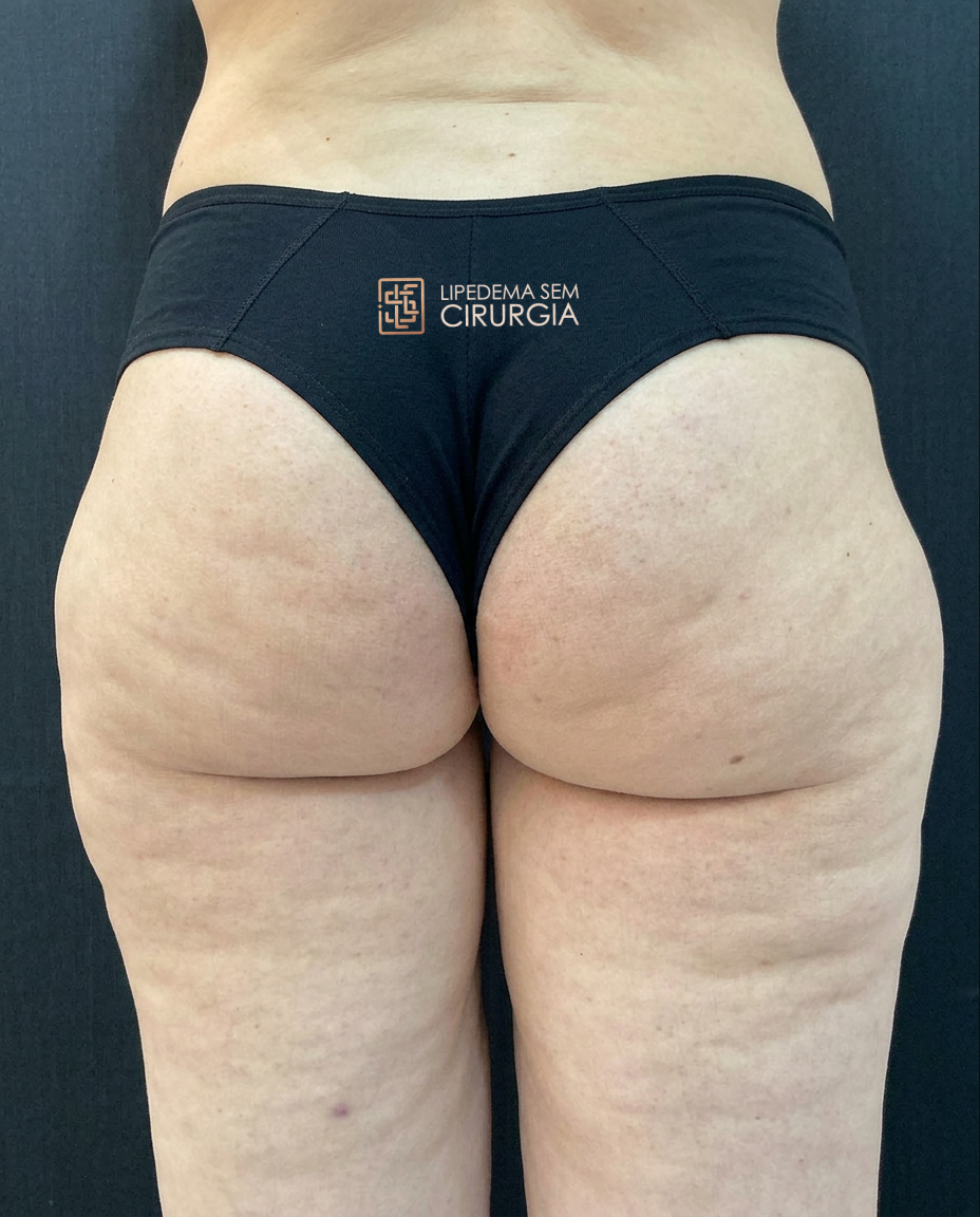 PERLA - CULOTES - ANTES