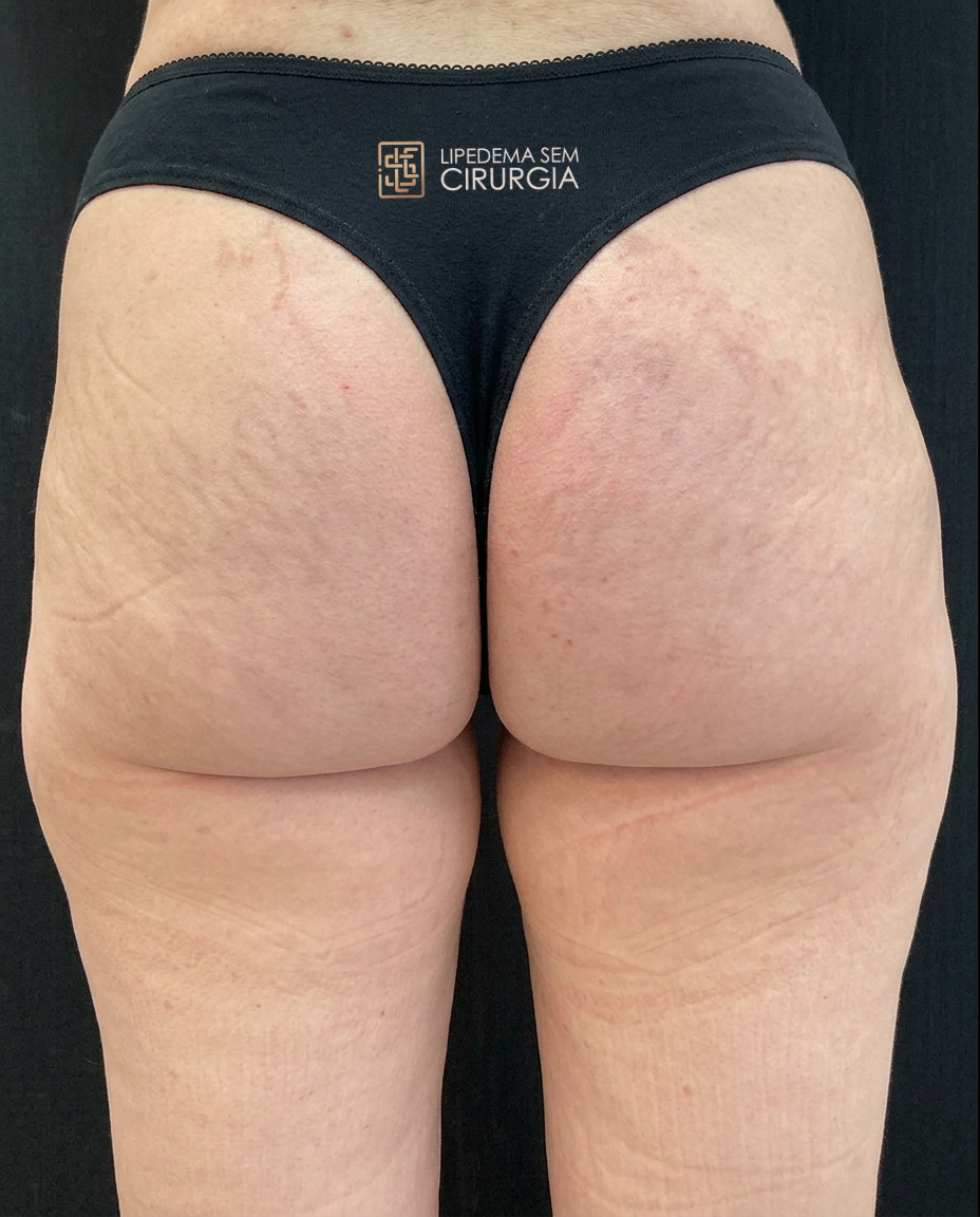 lipocube - antes -