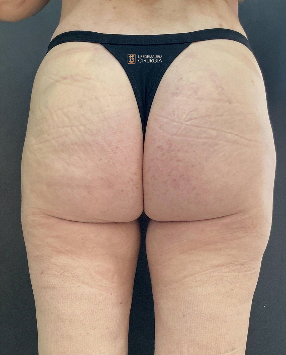 lipocube - depois -